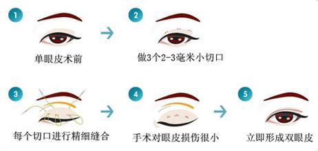 长春双眼皮,双眼皮哪里好,铭医双眼皮