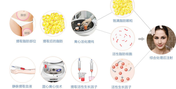 玻尿酸丰泪沟,爱贝芙丰泪沟,自体丰泪沟