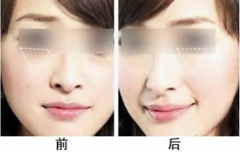 长春丰苹果肌,注射丰苹果肌,铭医丰苹果肌
