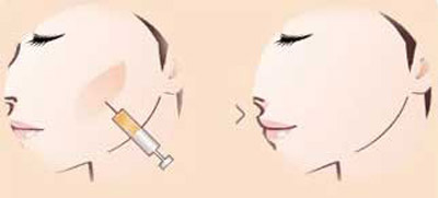 长春丰苹果肌,注射丰苹果肌,铭医丰苹果肌