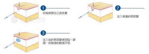 长春丰苹果肌,注射丰苹果肌,铭医丰苹果肌