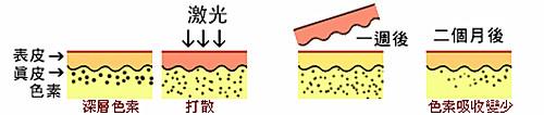 长春激光祛斑,铭医激光祛斑,激光祛斑价格