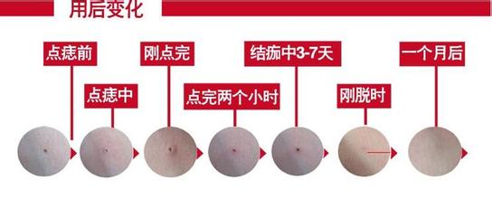长春激光点痣,激光点痣价格,铭医激光点痣