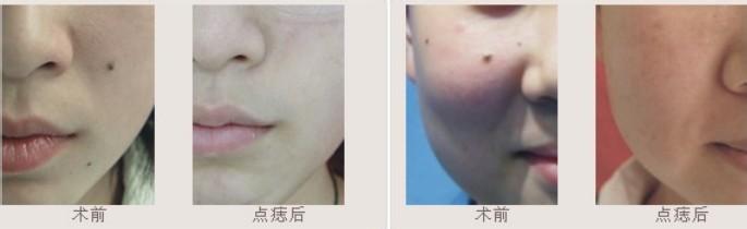 长春激光点痣,激光点痣价格,铭医激光点痣