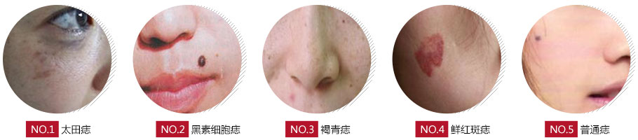 长春激光点痣,激光点痣价格,铭医激光点痣