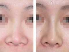 长春假体隆鼻,假体隆鼻价格,隆鼻哪里好