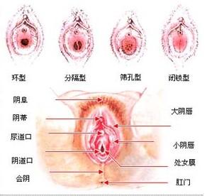 长春处女膜,处女膜修复
