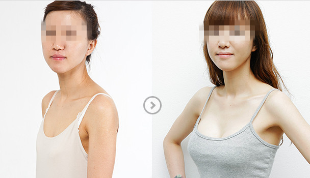 长春假体隆胸,隆胸哪里好,隆胸价格