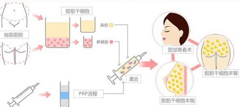 长春自体脂肪,填充面部