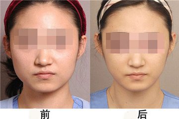 瘦脸对比图
