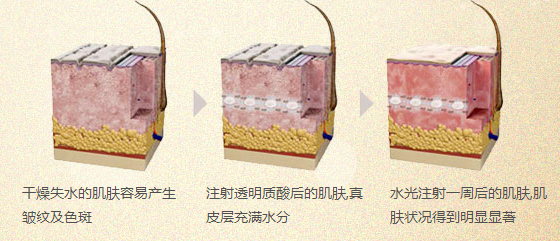 水光针对比图