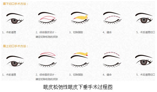 长春眼皮下垂,上睑下垂
