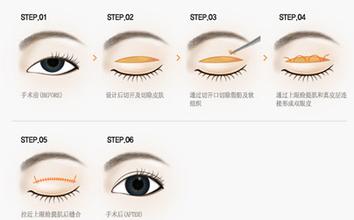长春眼皮下垂,上睑下垂