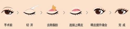 长春眼皮下垂,上睑下垂