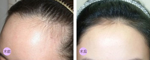 发际线脱毛