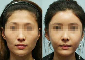 自体脂肪填充对比