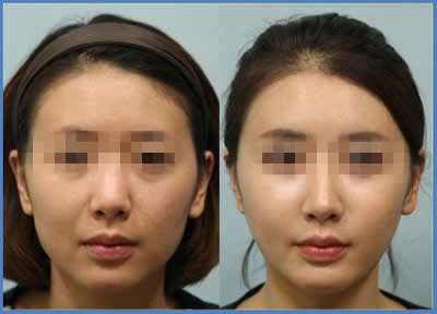 丰苹果肌对比