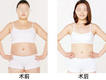 抽脂对比图