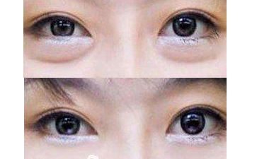 长春祛眼袋