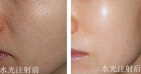 水光针对比