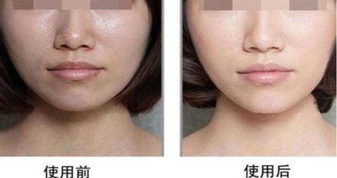黄金微针美容