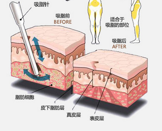 长春吸脂,水动力吸脂