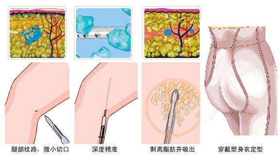 长春吸脂,水动力吸脂