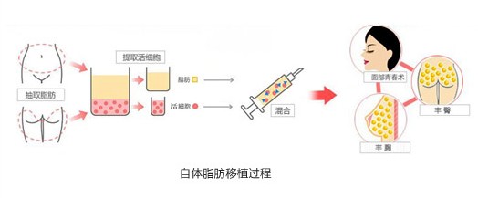 自体脂肪,丰胸,优点