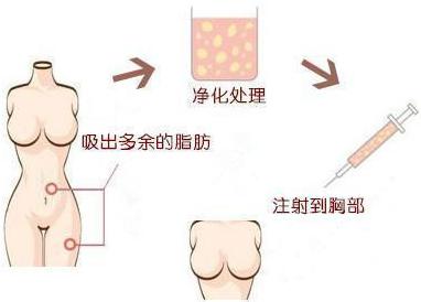 自体脂肪,隆胸,肥胖者