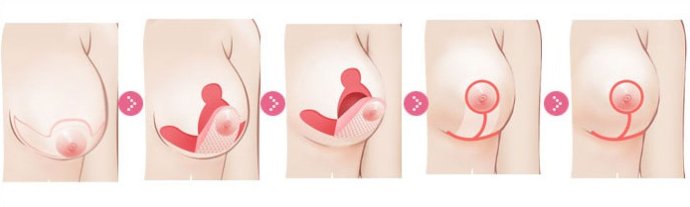 乳房下垂,乳房下垂矫正,吉林铭医