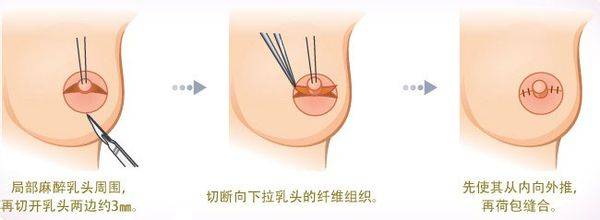 长春乳头再造,长春乳晕再造,长春乳头乳晕