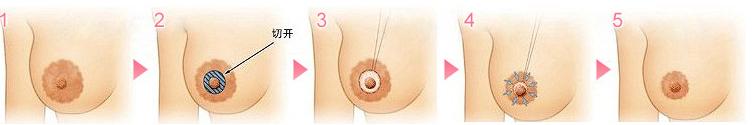 长春乳晕整形,长春乳晕缩小