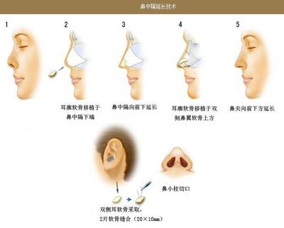 隆鼻,工作,休息
