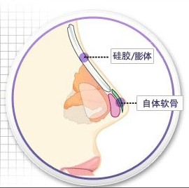 注射隆鼻、假体隆鼻:大对比
