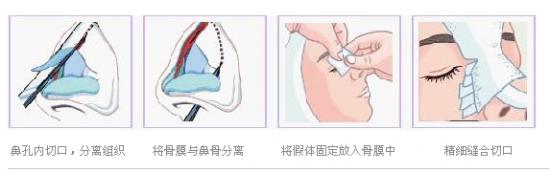 铭医专家:隆鼻不等于鼻部整形