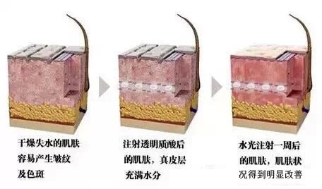 长春水光针,水光针效果