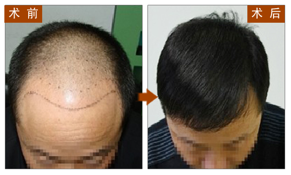 长春毛发移植,对比图,长春好的整形医院