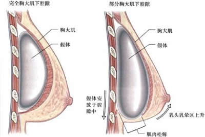 长春假体隆胸,5D内窥镜双平面假体隆胸