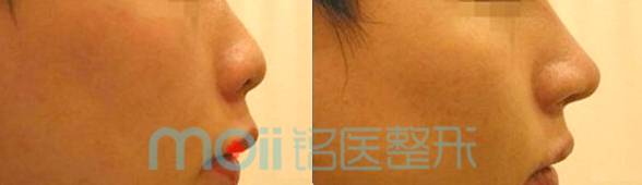 隆鼻,玻尿酸,对比图,长春好的整形医院
