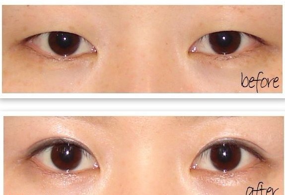 长春双眼皮,开眼角,对比图,长春好的整形医院