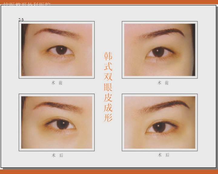 双眼皮,对比图,长春好的整形医院