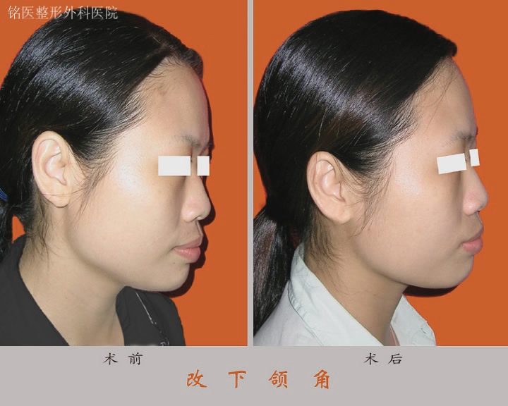 下颌角,对比图,长春好的整形医院