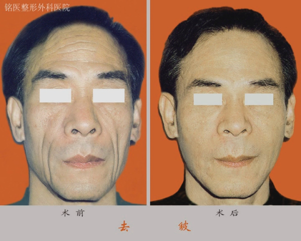 除皱,对比图,长春好的整形医院