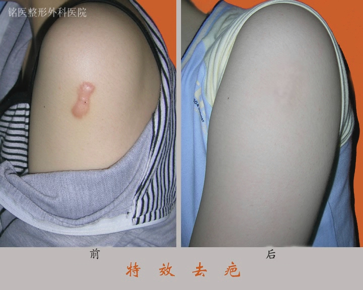激光祛疤,对比图,长春好的整形医院