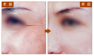 BOTOX,除皱,对比图,长春好的整形医院