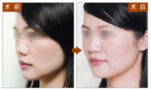 BOTOX,除皱,对比图,长春好的整形医院