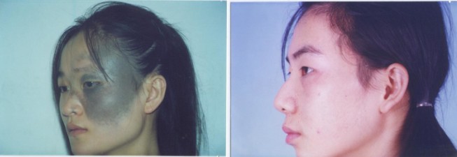 太田痣,对比图,长春好的整形医院