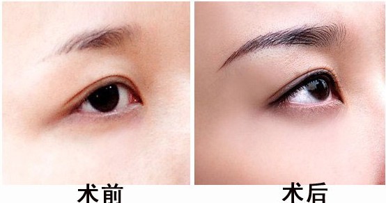 长春眉毛种植,对比图,长春好的整形医院