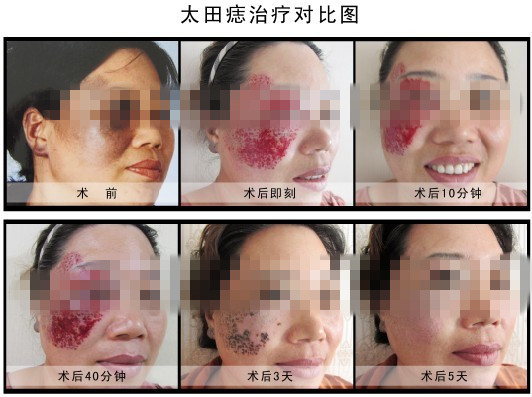 太田痣,治疗,过程,对比图,长春好的整形医院