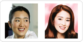 美容冠的种类有哪些